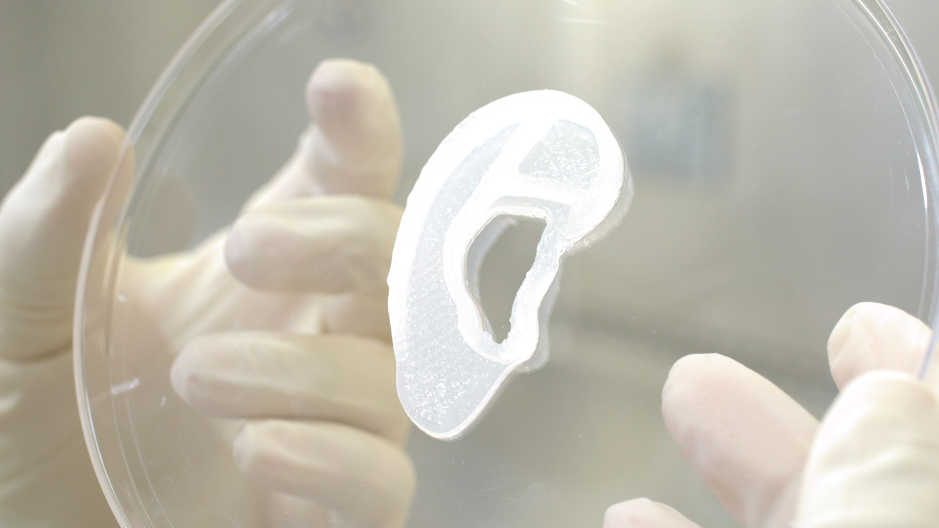 Human Ear Reconstruction Using 3D-Bioprinted Living Tissue Implant in a First-in-Human Clinical Trial
